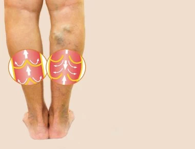 Φλεβική θρόμβωση: Συμπτώματα και ποιοι κινδυνεύουν